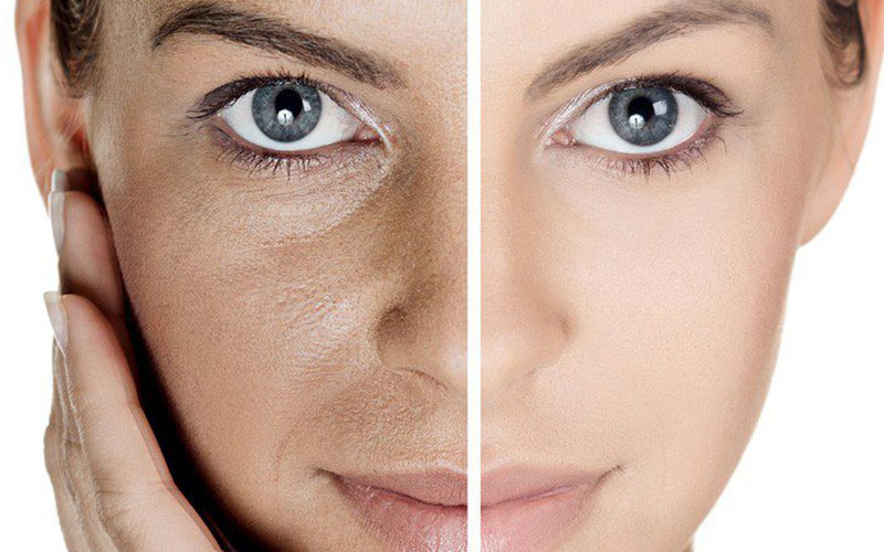 ۵ روش سریع برای درمان منافذ باز پوست صورت