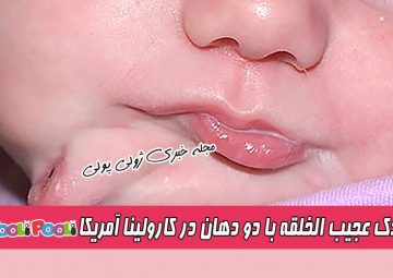تولد و جراحی کودک عجیب الخلقه با دو دهان در آمریکا+ علت تکرار اجزای صورت