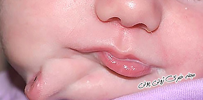 تولد کودک عجیب الخلقه با دو دهان در آمریکا